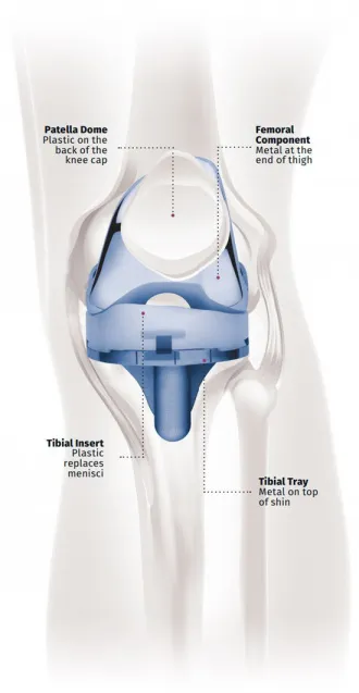 Knee implant