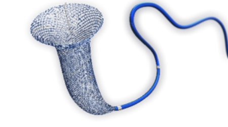 Intracranial aneurysm Tubrige 2