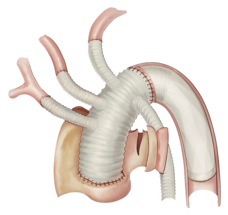 Thoracic Aortic Diseases CRONUS Stent Graft System in Surgical Operation LR2 1