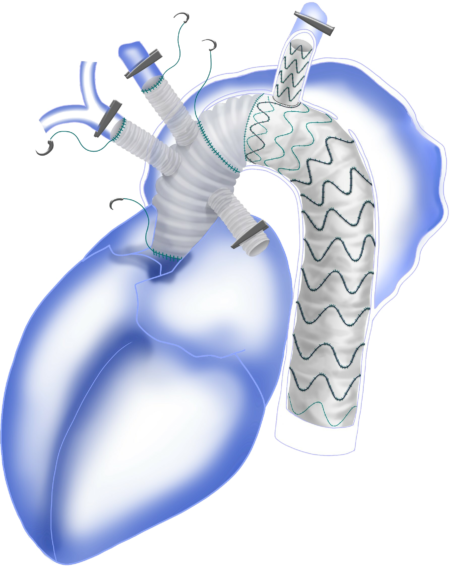 Thoracic Aortic Diseases Fontus Branched Stent Graft System in Surgical Operation copy 2