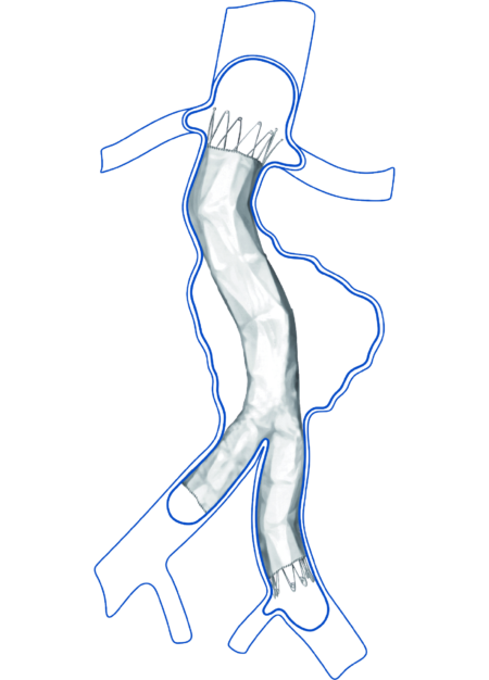 Abdominal Aortic Disease Aegis Bifurcated Aortic Stent Graft System 2