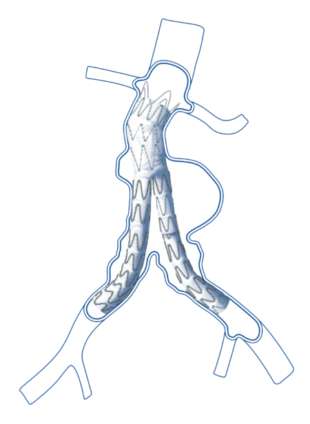 Abdominal Aortic Disease Hercules Bifurcated Stent Graft 3