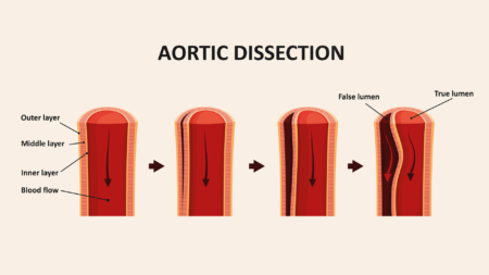 Endovascular Aortic dissection OK 1