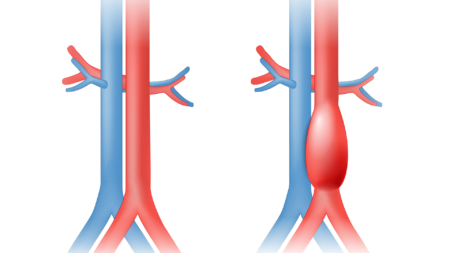 Endovascular Endovastec3 2