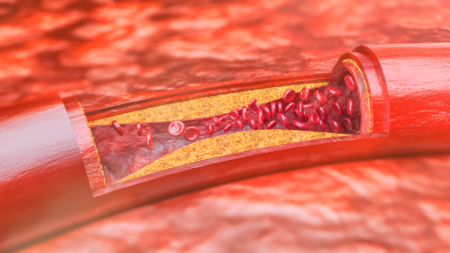 Endovascular Endovastec2 3