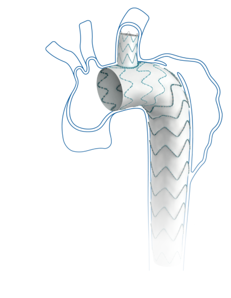 Thoracic Aortic Diseases Castor Branched Aortic Stent Graft System 1