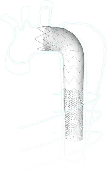 Thoracic Aortic Diseases Talos Thoracic Aortic Stent Graft System 3