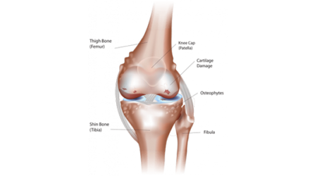 Understanding total knee replacement Knee arthritis 2