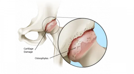Understanding Total Hip Replacement Arthritic hip 2
