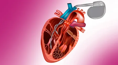 Bradycardia Patients Abnormal Heartbeat bradycardia4 4