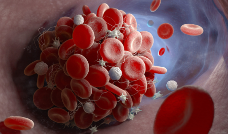 Stroke Hemorrhagic Stroke Prevention 2