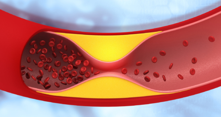 Severe Aortic Valve Stenosis Aortic Stenosis Disease 1