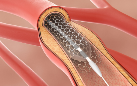 Arteriosclerosis Percutaneous Transluminal Angioplasty (PTA) 3